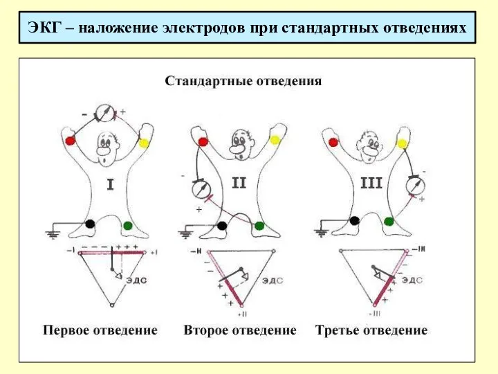 ЭКГ – наложение электродов при стандартных отведениях