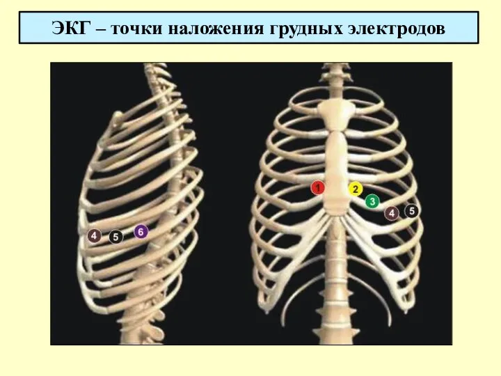 ЭКГ – точки наложения грудных электродов