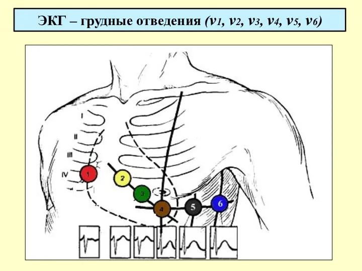 ЭКГ – грудные отведения (v1, v2, v3, v4, v5, v6)
