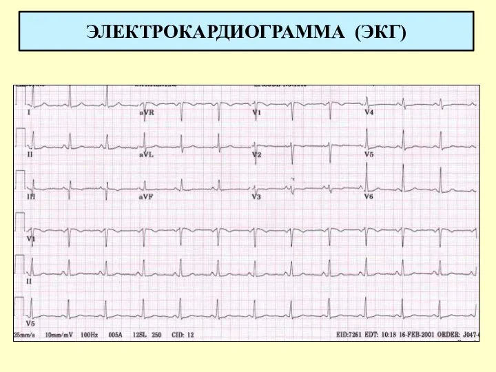 ЭЛЕКТРОКАРДИОГРАММА (ЭКГ)