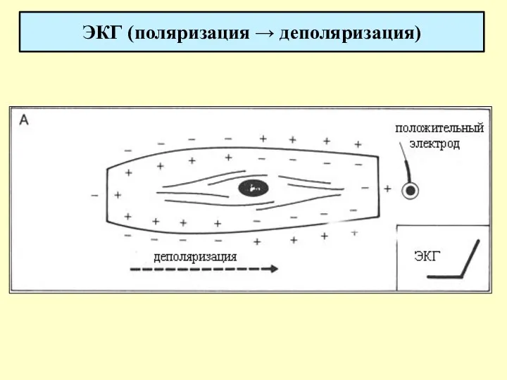 ЭКГ (поляризация → деполяризация)