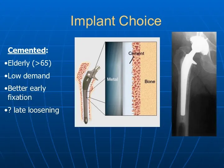 Implant Choice Cemented: Elderly (>65) Low demand Better early fixation ? late loosening