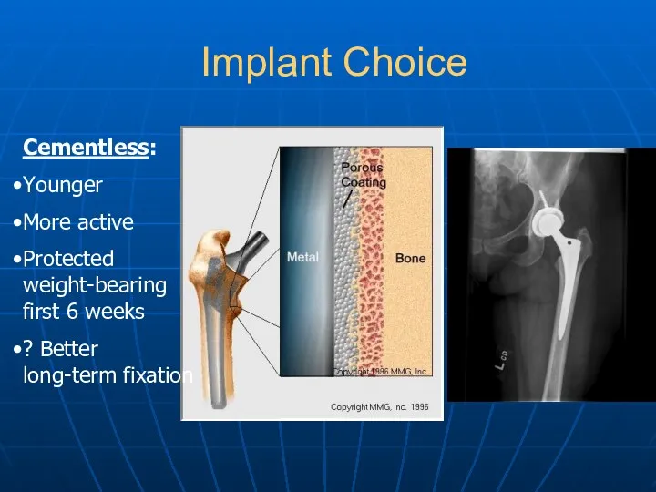 Implant Choice Cementless: Younger More active Protected weight-bearing first 6 weeks ? Better long-term fixation