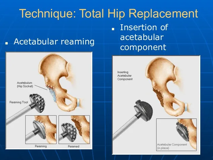 Technique: Total Hip Replacement Acetabular reaming Insertion of acetabular component