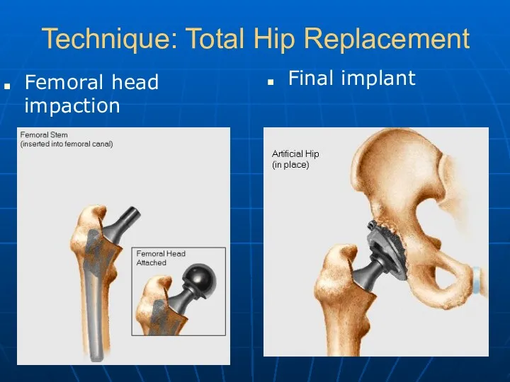 Technique: Total Hip Replacement Femoral head impaction Final implant