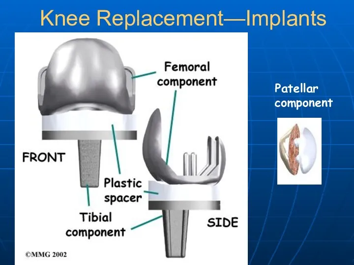 Knee Replacement—Implants Patellar component