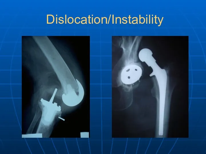 Dislocation/Instability