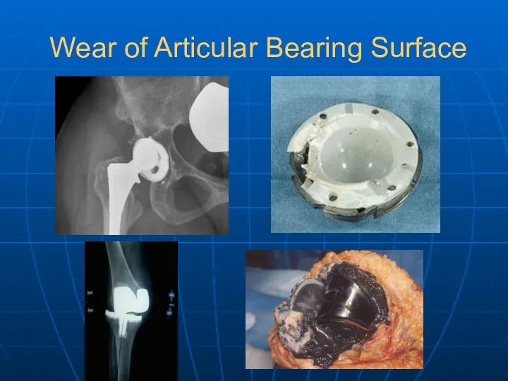Wear of Articular Bearing Surface