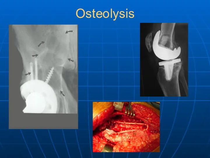 Osteolysis