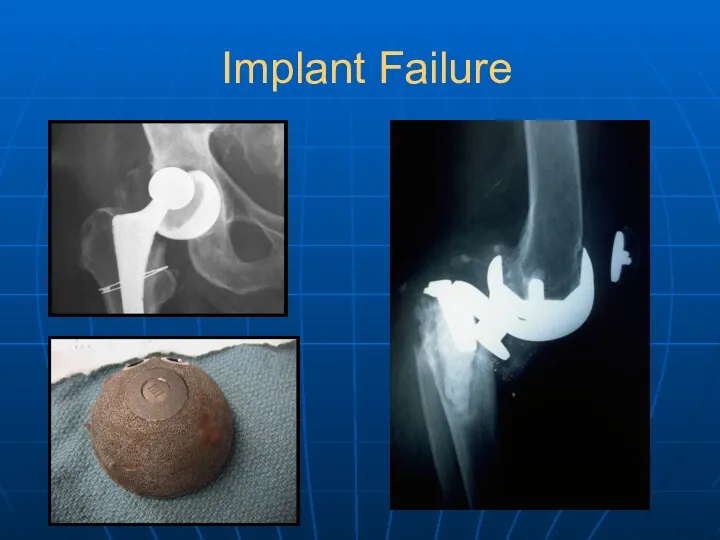 Implant Failure