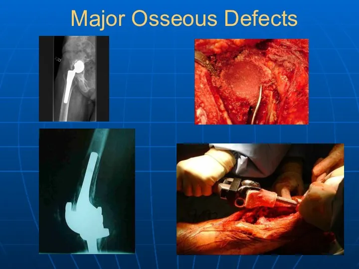 Major Osseous Defects