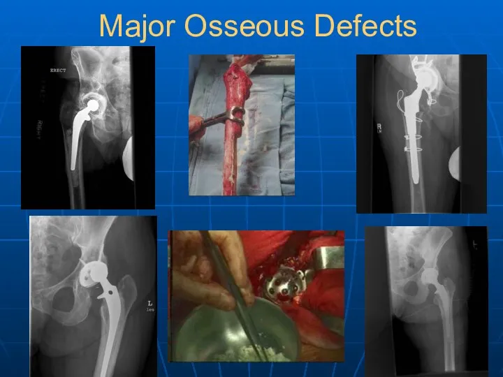 Major Osseous Defects