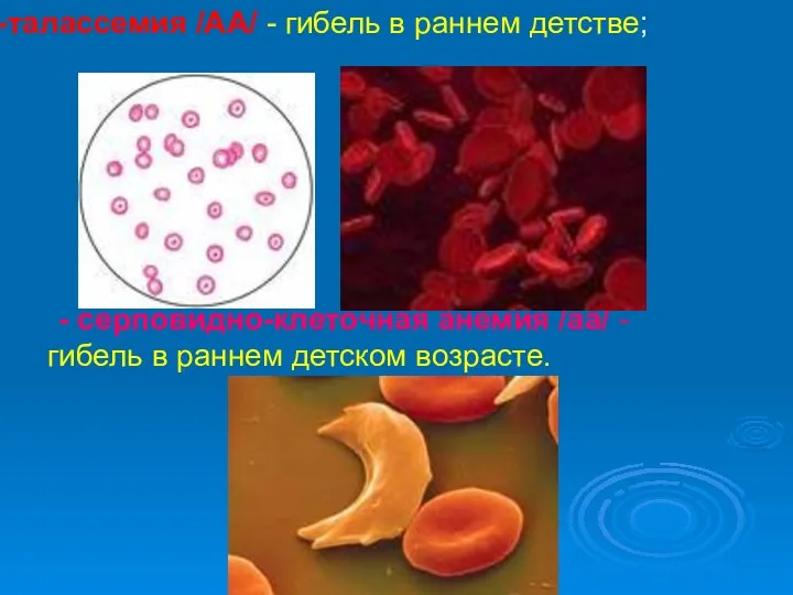 талассемия /АА/ - гибель в раннем детстве; - серповидно-клеточная анемия /аа/ - гибель