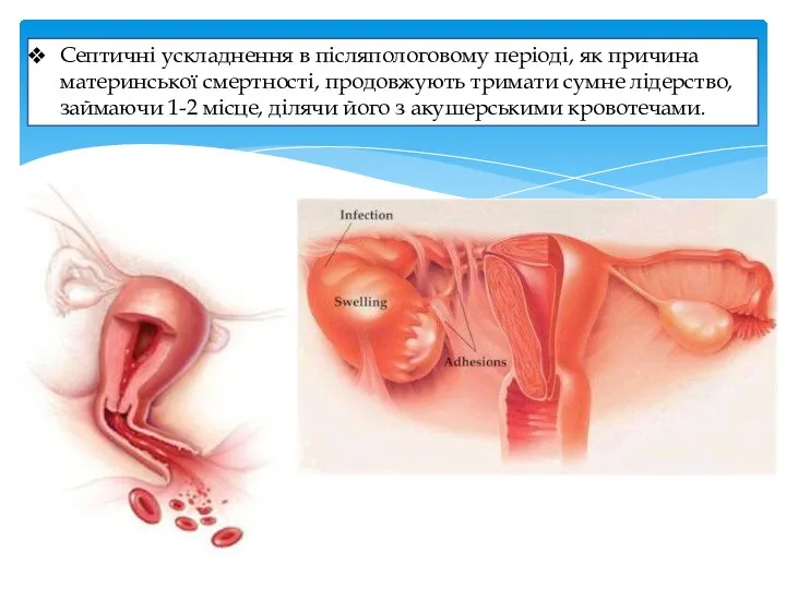 Септичні ускладнення в післяпологовому періоді, як причина материнської смертності, продовжують