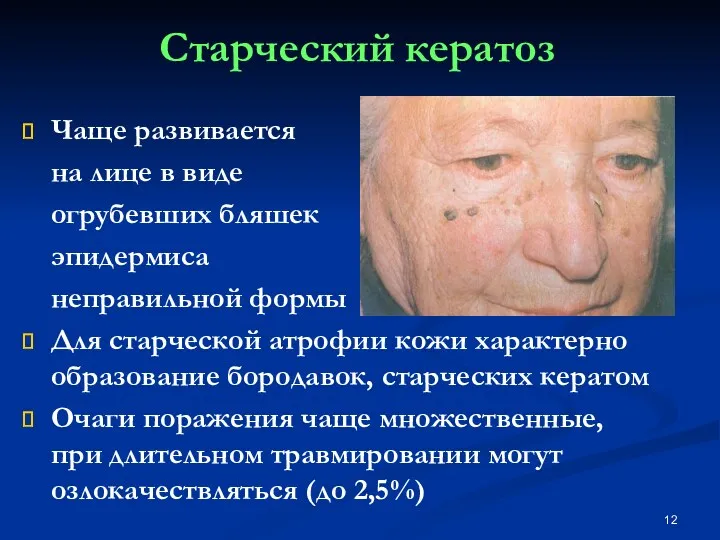 Старческий кератоз Чаще развивается на лице в виде огрубевших бляшек