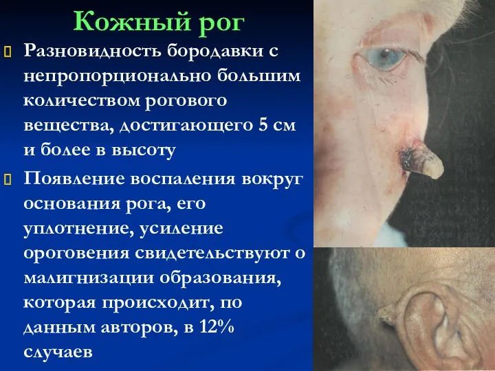 Кожный рог Разновидность бородавки с непропорционально большим количеством рогового вещества,