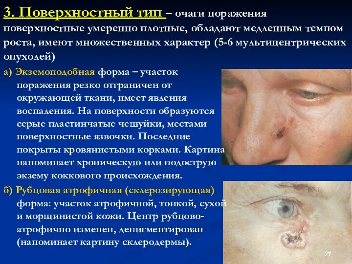 а) Экземоподобная форма – участок поражения резко отграничен от окружающей