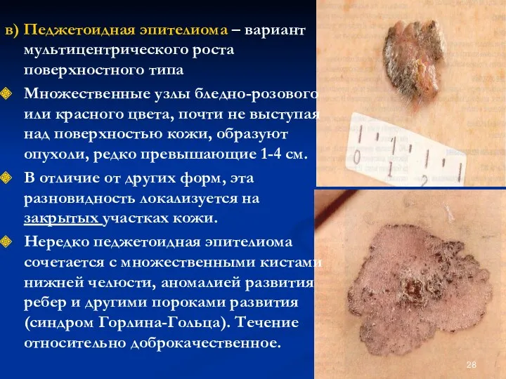 в) Педжетоидная эпителиома – вариант мультицентрического роста поверхностного типа Множественные