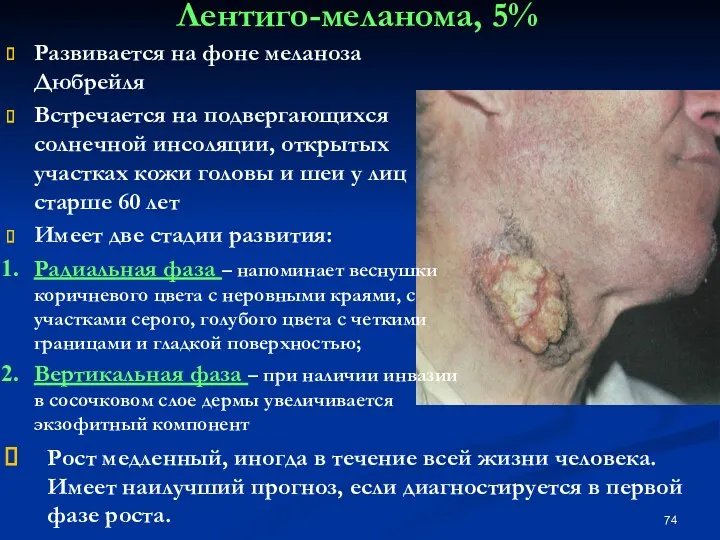 Лентиго-меланома, 5% Развивается на фоне меланоза Дюбрейля Встречается на подвергающихся