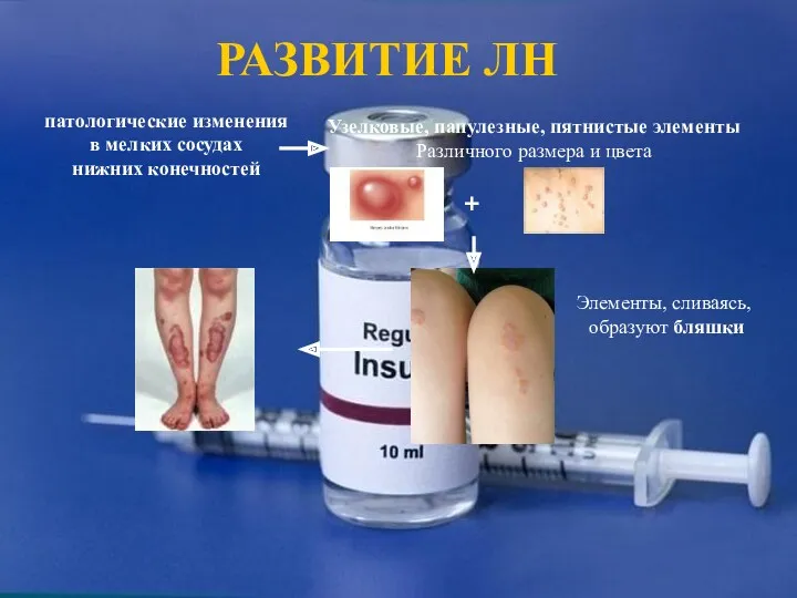 РАЗВИТИЕ ЛН патологические изменения в мелких сосудах нижних конечностей Узелковые,