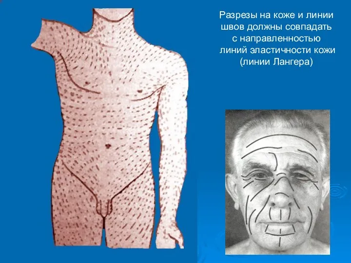 Разрезы на коже и линии швов должны совпадать с направленностью линий эластичности кожи (линии Лангера)