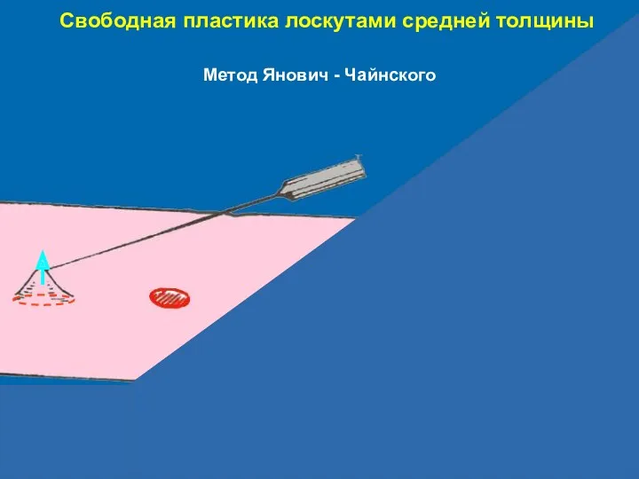 Свободная пластика лоскутами средней толщины Метод Янович - Чайнского