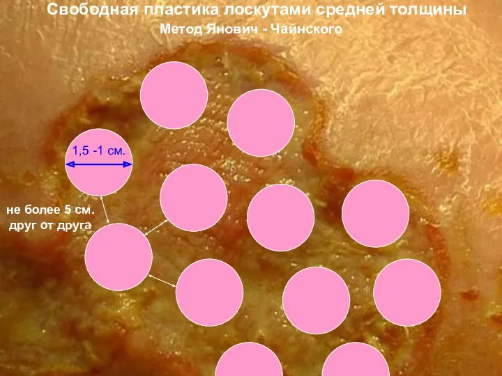 Свободная пластика лоскутами средней толщины Метод Янович - Чайнского 1,5