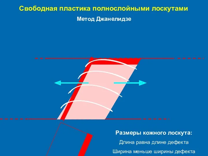 Свободная пластика полнослойными лоскутами Метод Джанелидзе Размеры кожного лоскута: Длина