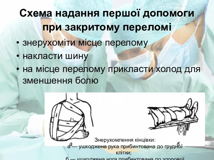 Схема надання першої допомоги при закритому переломі знерухоміти місце перелому