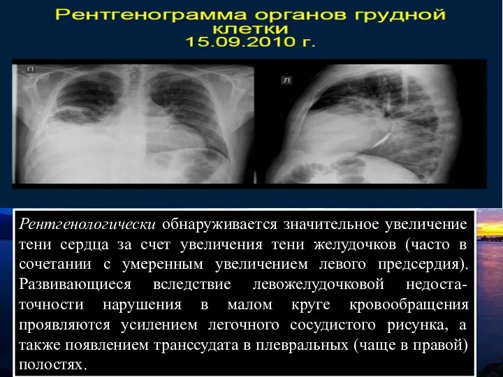 Рентгенологически обнаруживается значительное увеличение тени сердца за счет увеличения тени