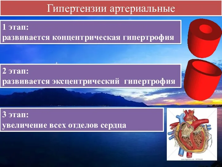Гипертензии артериальные 1 этап: развивается концентрическая гипертрофия 2 этап: развивается