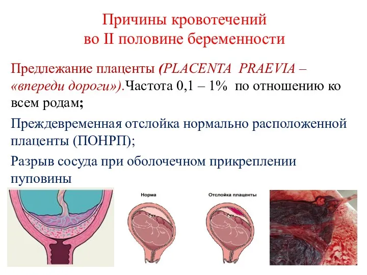 Причины кровотечений во II половине беременности Предлежание плаценты (PLACENTA PRAEVIA – «впереди дороги»).Частота