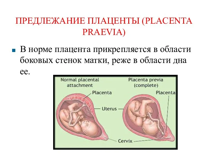 ПРЕДЛЕЖАНИЕ ПЛАЦЕНТЫ (PLACENTA PRAEVIA) В норме плацента прикрепляется в области боковых стенок матки,