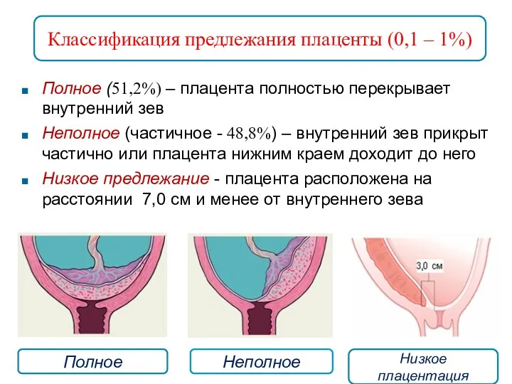Полное (51,2%) – плацента полностью перекрывает внутренний зев Неполное (частичное - 48,8%) –