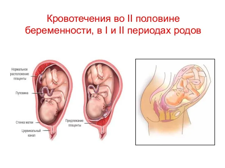 Кровотечения во II половине беременности, в I и II периодах родов