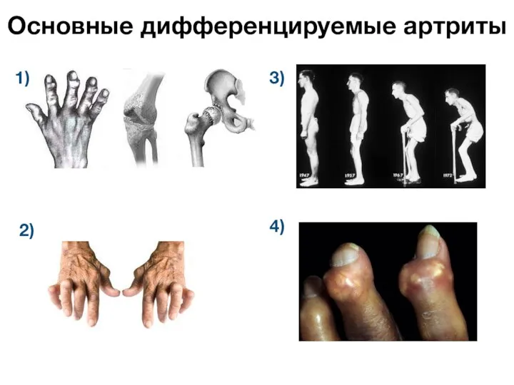 Основные дифференцируемые артриты 1) 3) 2) 4)