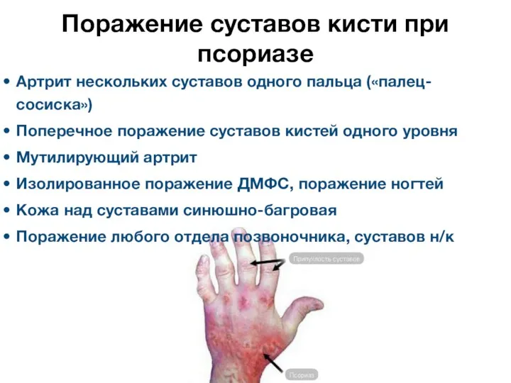 Поражение суставов кисти при псориазе Артрит нескольких суставов одного пальца («палец-сосиска») Поперечное поражение
