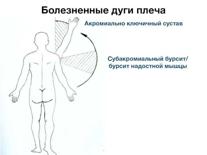 Болезненные дуги плеча Субакромиальный бурсит/ бурсит надостной мышцы Акромиально ключичный сустав