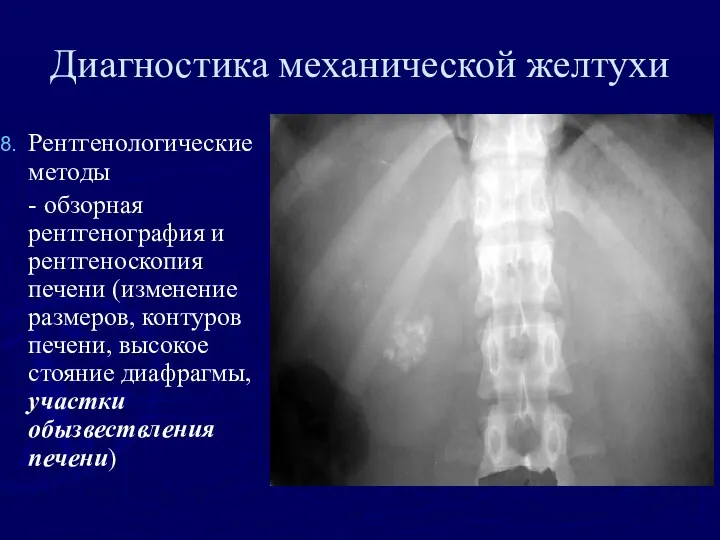 Диагностика механической желтухи Рентгенологические методы - обзорная рентгенография и рентгеноскопия