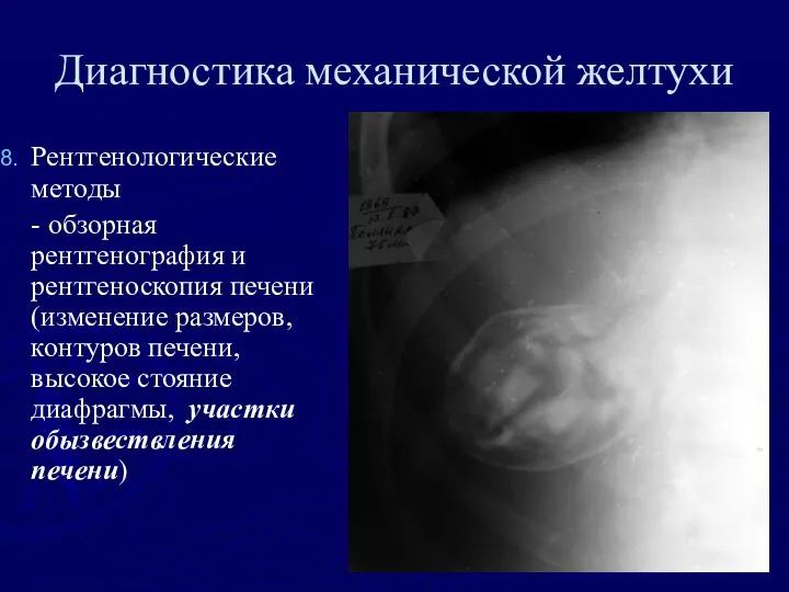 Диагностика механической желтухи Рентгенологические методы - обзорная рентгенография и рентгеноскопия