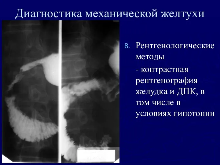 Диагностика механической желтухи Рентгенологические методы - контрастная рентгенография желудка и