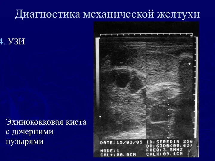 Диагностика механической желтухи УЗИ Эхинококковая киста с дочерними пузырями