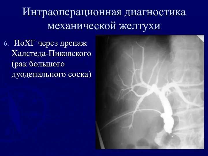 Интраоперационная диагностика механической желтухи ИоХГ через дренаж Халстеда-Пиковского (рак большого дуоденального соска)