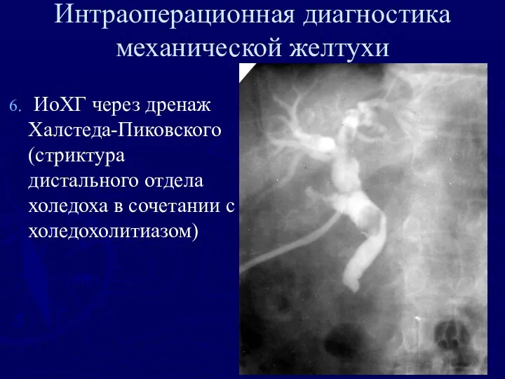 Интраоперационная диагностика механической желтухи ИоХГ через дренаж Халстеда-Пиковского (стриктура дистального отдела холедоха в сочетании с холедохолитиазом)