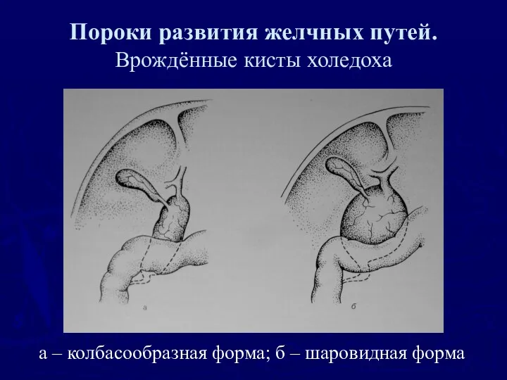 Пороки развития желчных путей. Врождённые кисты холедоха а – колбасообразная форма; б – шаровидная форма