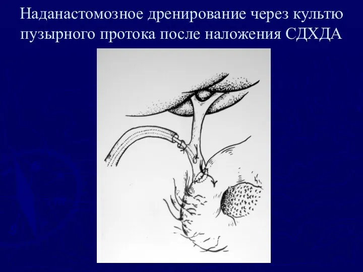 Наданастомозное дренирование через культю пузырного протока после наложения СДХДА