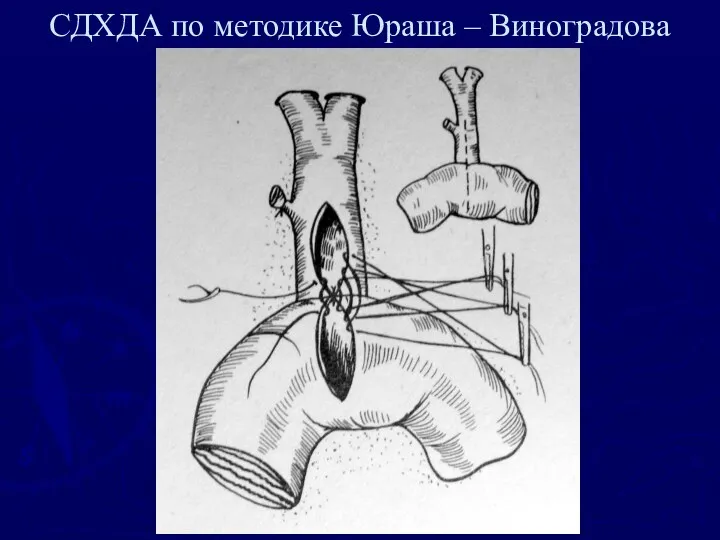 СДХДА по методике Юраша – Виноградова