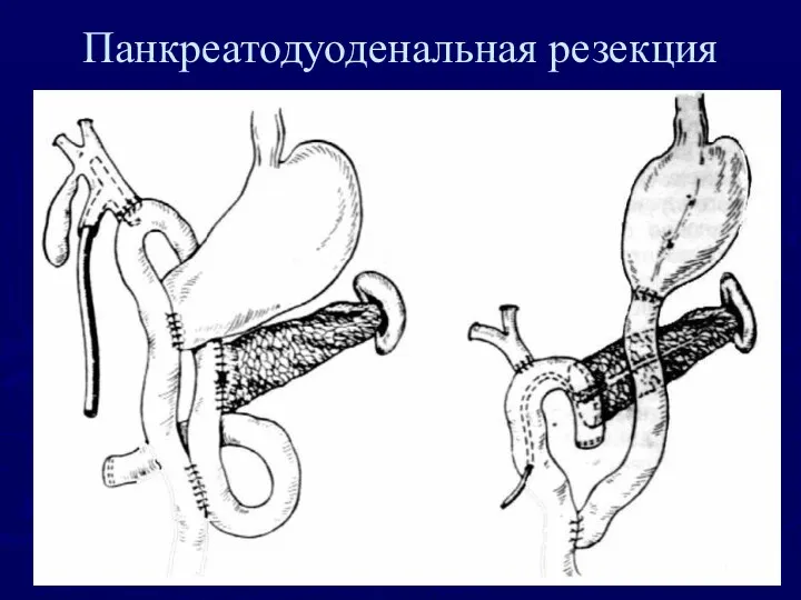 Панкреатодуоденальная резекция