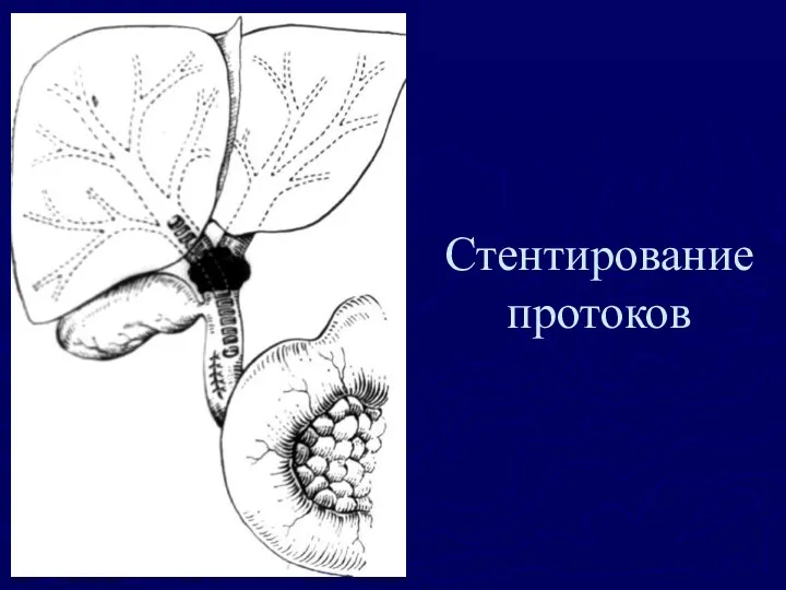 Стентирование протоков