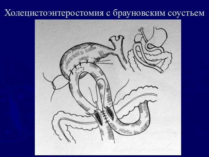 Холецистоэнтеростомия с брауновским соустьем